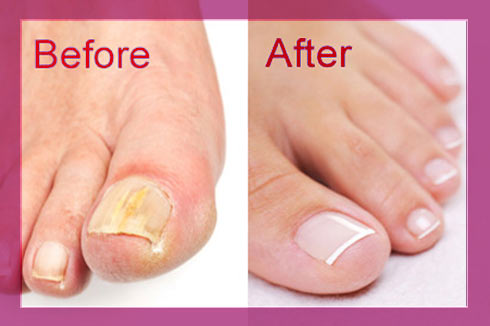 ViZiON Hair & Beauty Toenail reconstruction