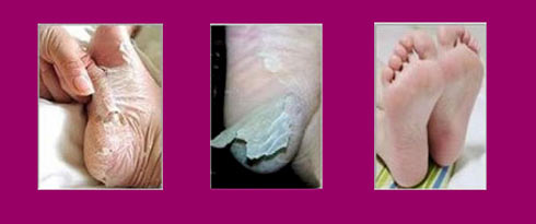 ViZiON Hair & Beauty Heel Peel